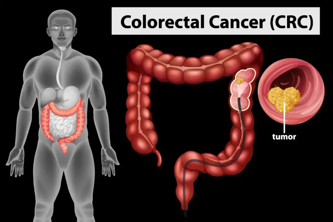 Colorectal Cancer : बदलती जीवनशैली और खानपान की आदतें बढ़ा रही है, कम उम्र में कोलोरेक्टल कैंसर की समस्या : डॉ० अमित सहरावत